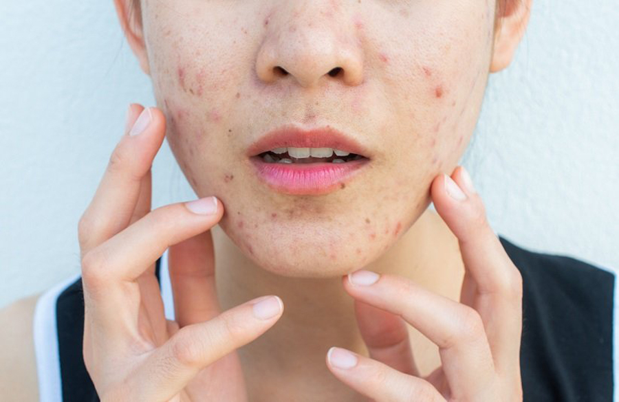 درمان جای جوش