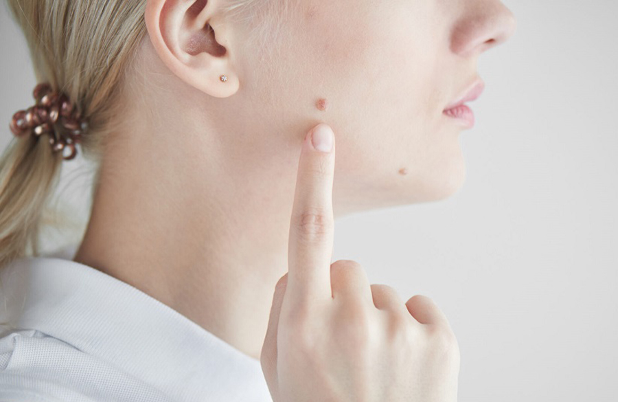 روشهایی برای برداشتن خال در خانه