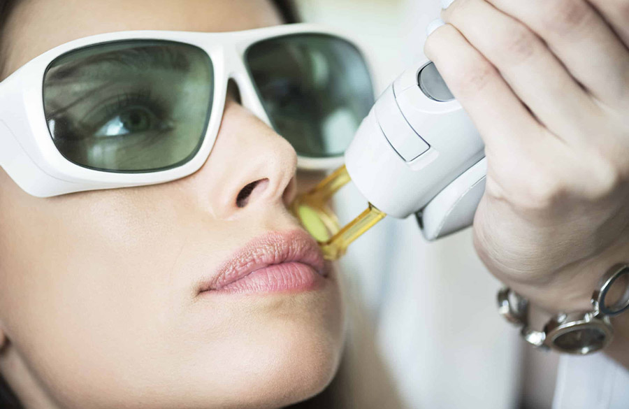 لیزر موی صورت