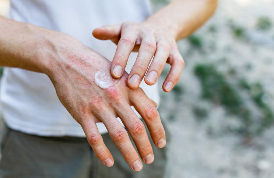 اگزما در بهار