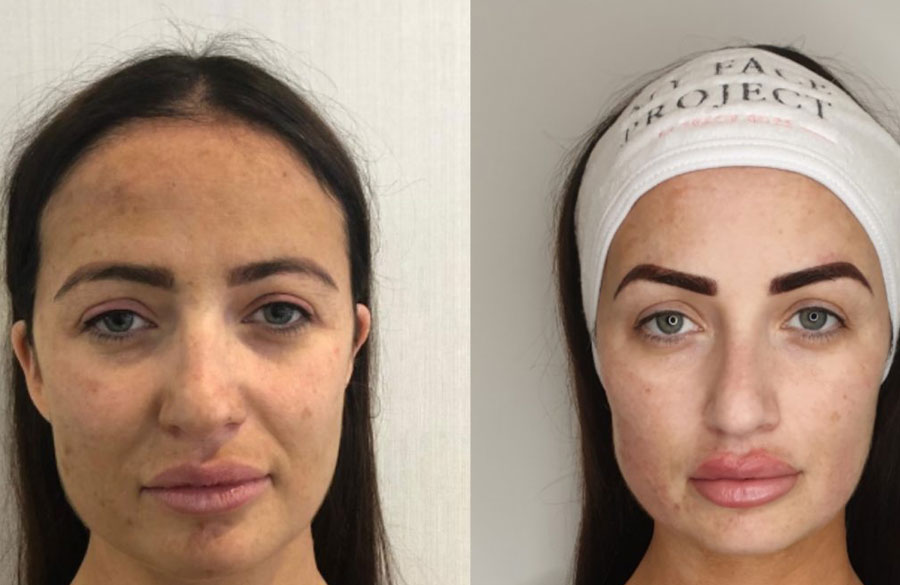 لیفت ابرو با جراحی