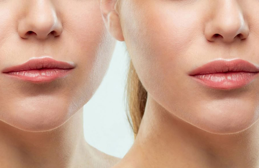 حجم دادن به لبها با چربی